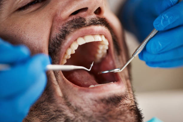 Best Emergency Dental Care for Broken or Chipped Teeth in Osborne, KS