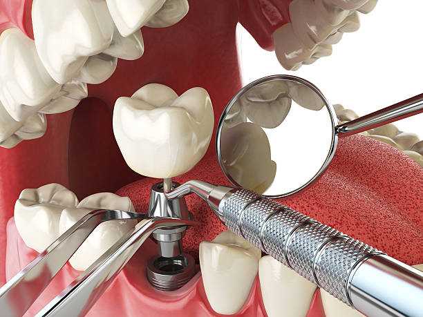 Best Emergency Dental Care for Broken or Chipped Teeth in Osborne, KS